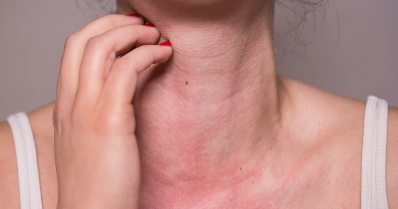 大人も注意！チーズアレルギーの症状・原因と対策：快適な食生活のために